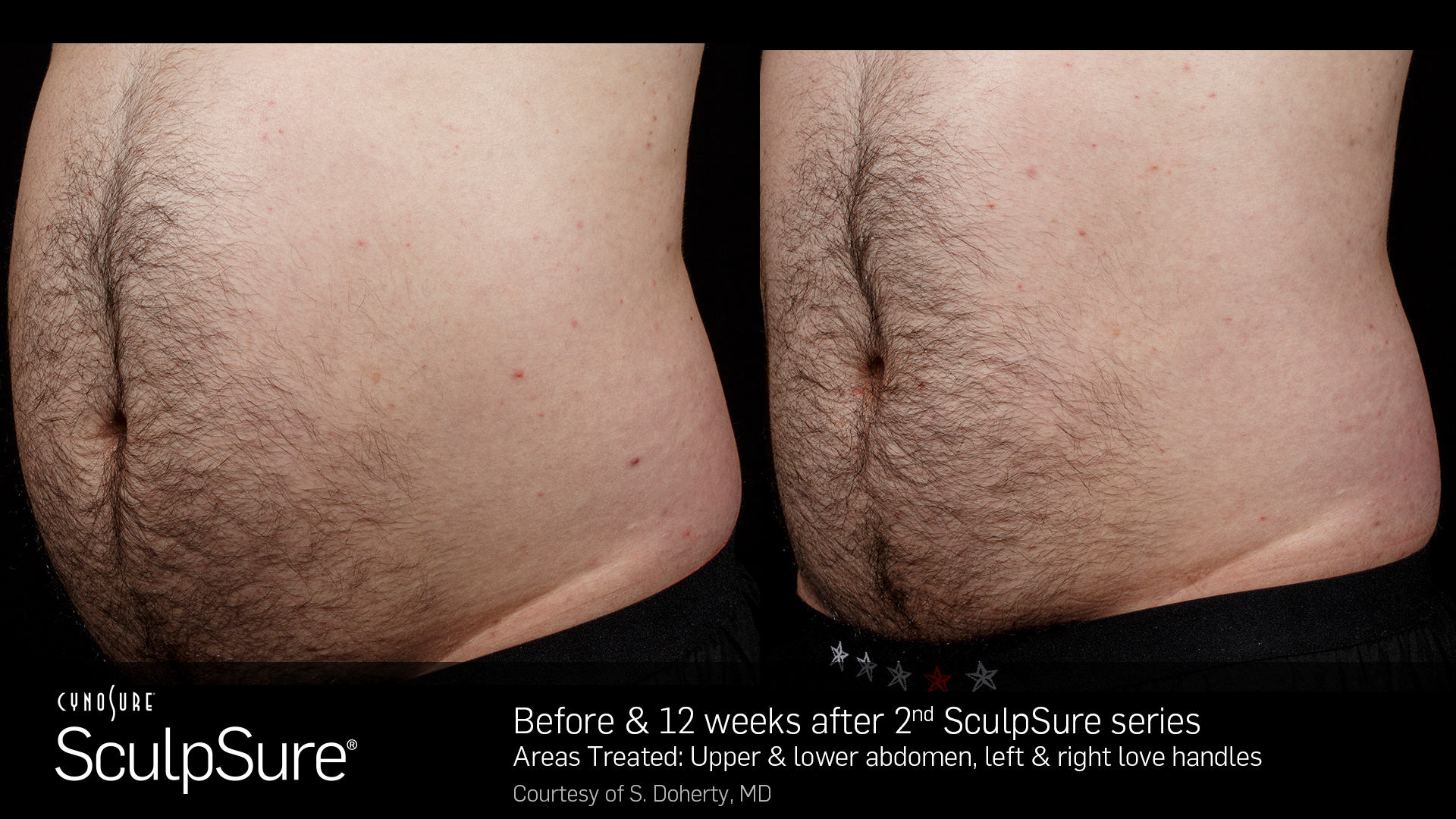 SculpSure Example - Abdomen & Love Handles