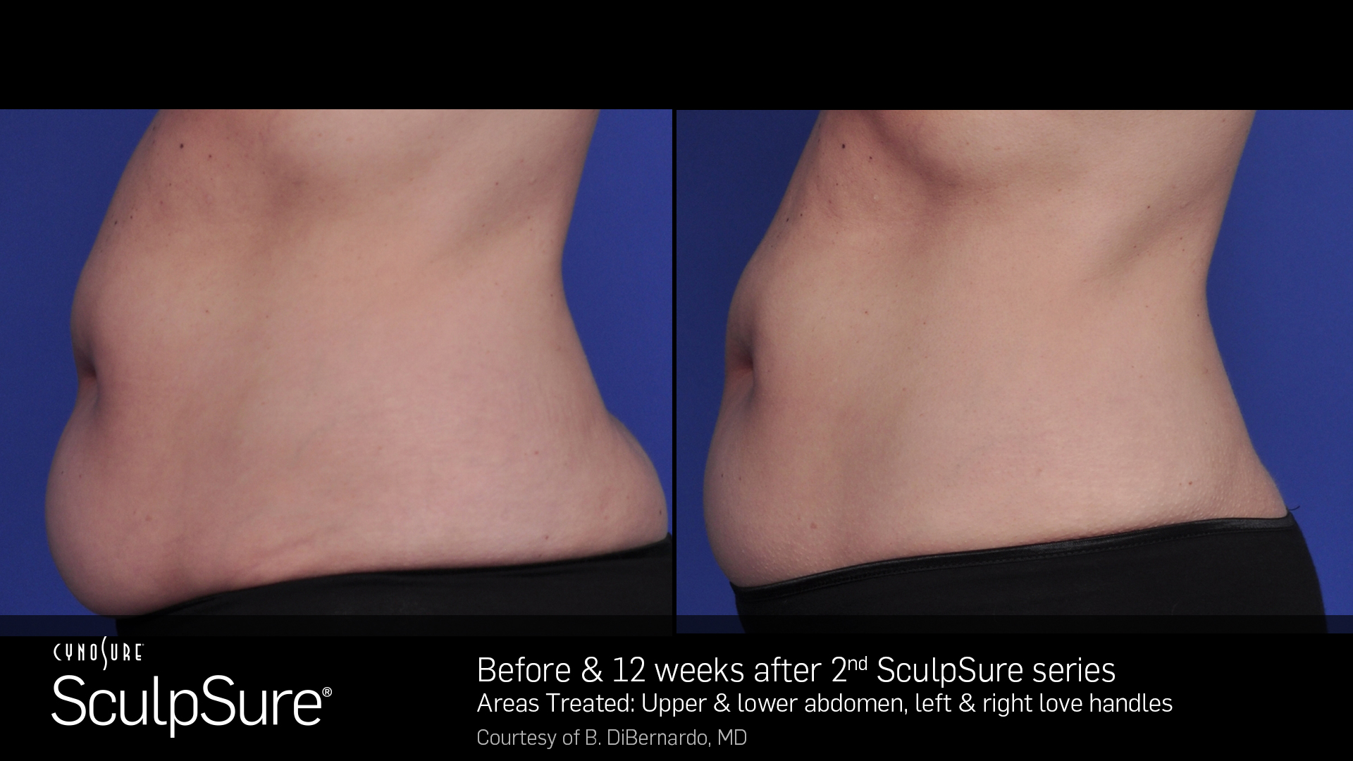 SculpSure Example - Abdomen & Love Handles