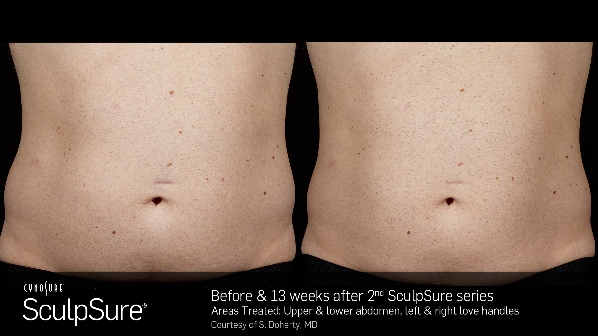 SculpSure Example - Abdomen & Love Handles