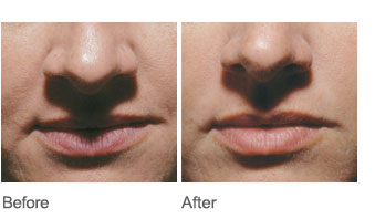 Neocutis Before and After example 1